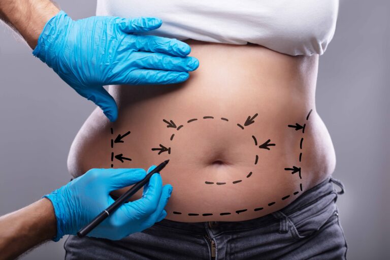 Read more about the article Saiba tudo sobre a abdominoplastia